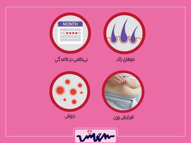 علائم تنبلی تخمدان (PCOS)